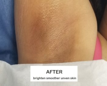 Close-up of an underarm with smoother, more even-toned skin; “AFTER” label and text about brightening and smoothing.
