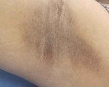 Close-up of a person’s armpit with visible dark patches and hair, labeled “BEFORE Dark Armpits.”.