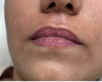 Close-up of a person’s lower face showing uneven, faded purple-pink lipstick and natural skin texture.