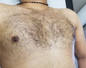 A close-up of a person’s bare, hairy chest and upper abdomen as they lie down on a medical exam table.