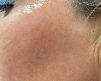 Close-up of a woman’s cheek showing redness and shiny skin, with visible eyebrow, eye makeup, and hairline.