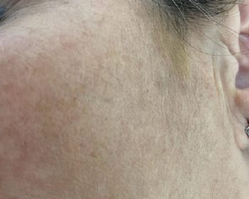 Close-up of a person’s cheek and ear, showing skin texture, fine hair, and slight discoloration near the hairline.