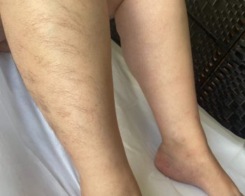 Two legs side by side, one with visible hair and the other smooth and hairless, resting on a white surface.